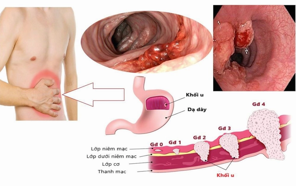 Bác sĩ tư vấn cho bệnh nhân về việc tầm soát ung thư dạ dày định kỳ