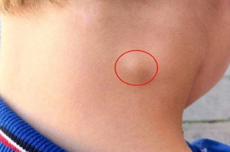 Hạch bạch huyết sưng to ở cổ và xương đòn là triệu chứng phổ biến của u lympho