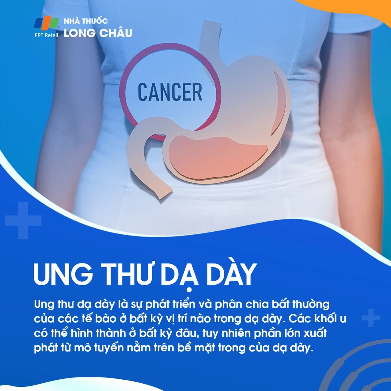Hình ảnh minh họa cấu trúc giải phẫu của dạ dày và vị trí khối u ác tính