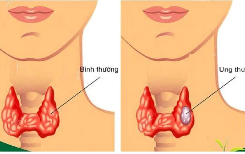 Minh họa quá trình di căn của ung thư hạch bạch huyết sang các cơ quan khác